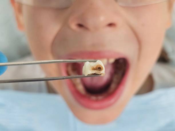 Best Emergency Treatment for Dental Infections or Abscesses in Gruver, TX